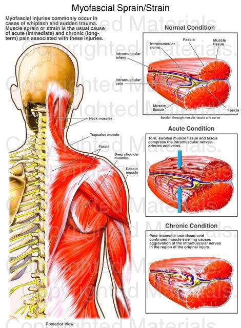 Myofascial Pain Syndrome | lupon.gov.ph