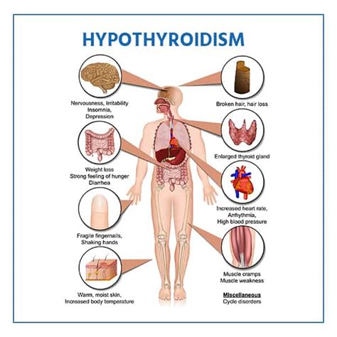 Medication For Hypothyroidism: Tips & Supplements - Livofy