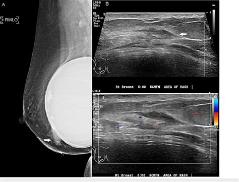 (A) Initial mammogram upon presentation showing an asymmetry (arrow)... | Download Scientific ...