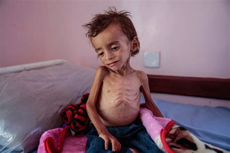 Opinion | 85,000 children may have starved to death in Yemen. They deserve more attention. - The ...