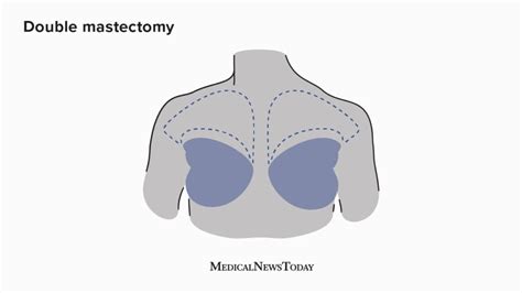 Mastectomy Anatomy