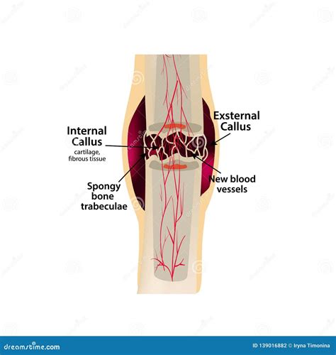 2 Stage Of Healing Bone Fracture. Formation Of Callus. The Bone ...