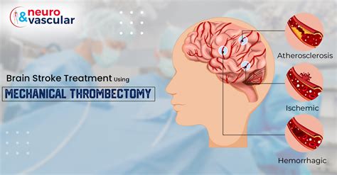 Brain Stroke Treatment using Mechanical Thrombectomy