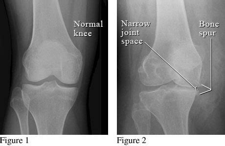 knee pain diagnosis xray