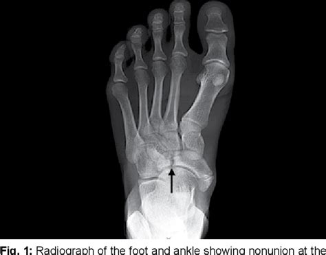 Navicular Fracture Cause, Symptoms, Treatment,, 49% OFF