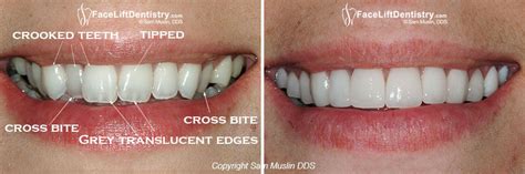 Adult Crossbite Correction Without Braces