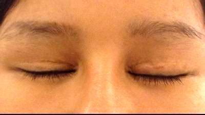 Recovery After Eyelid Surgery » Eyelid Surgery: Cost, Photos, Rewiews, Q&A