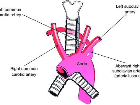 Aberrant Subclavian Artery | atelier-yuwa.ciao.jp