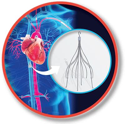 Inferior Vena Cava (IVC) Filter Placement and Removal – New England Endovascular Center