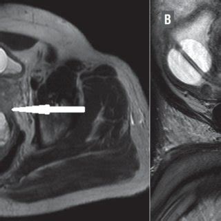 A and B): Hemorrhagic cyst (arrow) at initial presentation. | Download Scientific Diagram