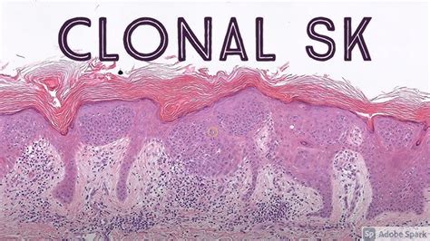 Atypical Fibroxanthoma Histology