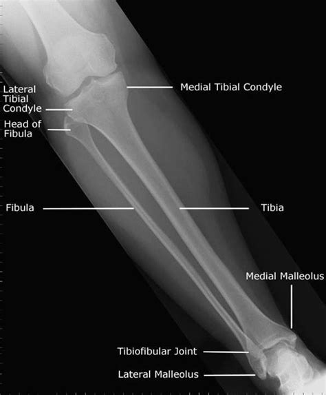 Tib/fib anatomy | Radiography | Anatomy, physiology, Medical coding ...