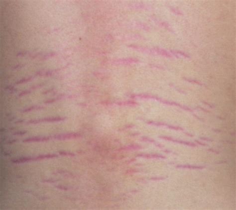 Stretch Marks Explained: Causes, Prevention, and Treatments - StretchMarks.org