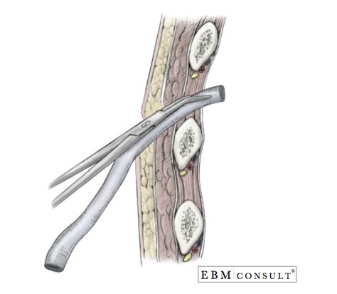 Chest Tube Placement Thoracostomy Procedure