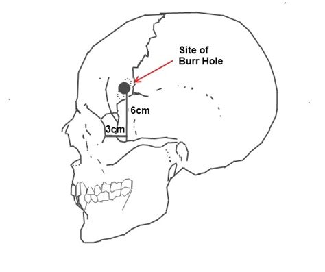 Lobotomy (prefrontal leukotomy) - what it was about, side effects - Healthy Food Near Me