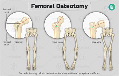 Femoral osteotomy: Procedure, Purpose, Results, Cost, Price