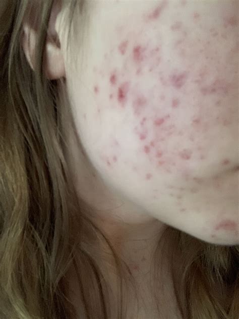 Red marks left over from acne. Any suggestions? - Hyperpigmentation - red/dark marks - Acne.org