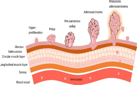 Stages Of Colorectal Cancer