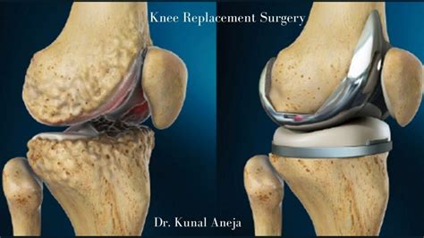 What is knee replacement surgery