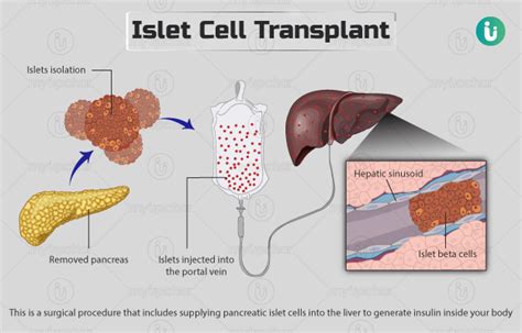 Islet cell transplant: Procedure, Purpose, Results, Cost, Price, Indications, Recovery