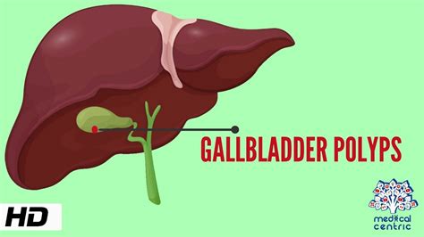 Gallbladder Polyp, Causes, Signs and Symptoms, Diagnosis and Treatment. - YouTube