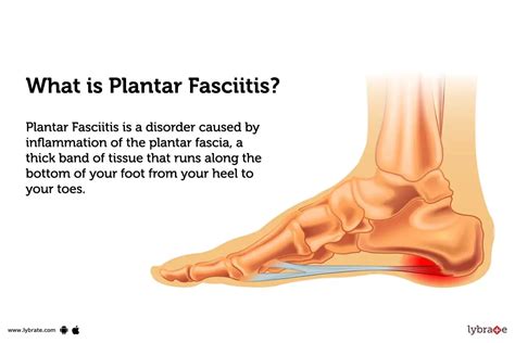 Plantar Fasciitis: Causes, Symptoms, Treatment and Cost