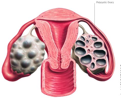 Polycystic Ovarian Syndrome (PCOS) - Fertility Solutions