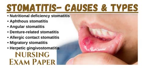 STOMATITIS- Causes, Types & Sign/Symptoms - Nursing Exam Paper