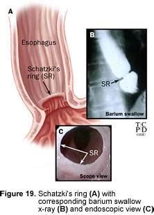 MEDICAL IMAGES: Schatzki's ring