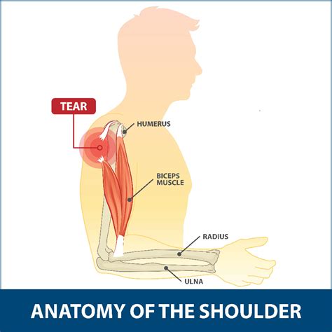 Bicep Tendon Tear Info | Florida ... Muscle Tear, Muscle Pain, Tendon Tear, Upper Arm Bone ...