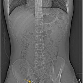 A preoperative CT scan of the mastoid at the level of the mesotympanum... | Download Scientific ...