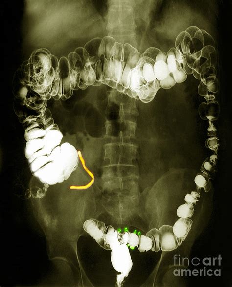 Colon X-ray With Barium Contrast Photograph by Scott Camazine - Pixels