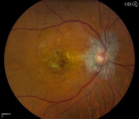 Cystoid Macular Edema - Retina Image Bank