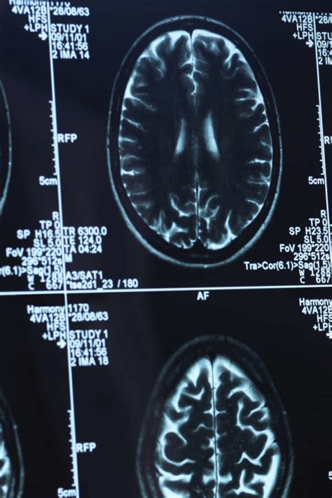 Encephalopathy: Types, causes, symptoms, and treatment