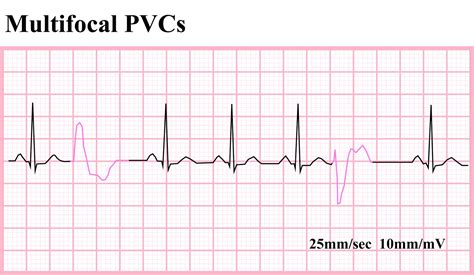 ECG Educator Blog : Ventricular Ectopics