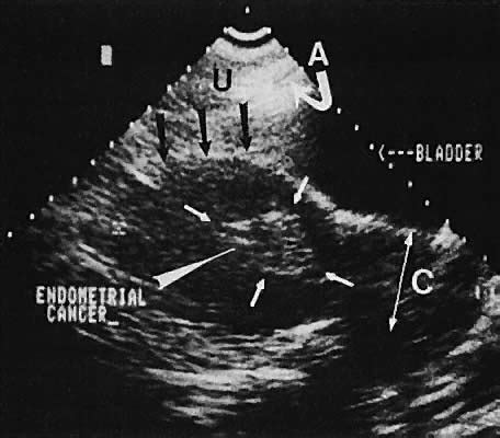 Reverberation Artifact Ultrasound