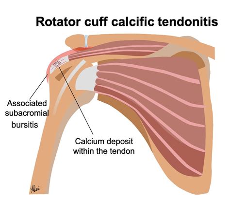 Ultrasound-Guided Shoulder Barbotage for Calcific Tendonitis