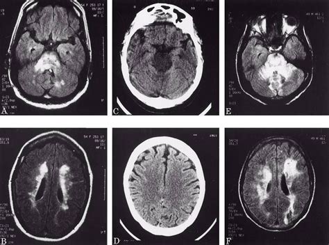 Hypertensive Encephalopathy - MEDizzy