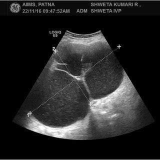 19.5 x 11.3 cm septated ovarian cyst. | Download Scientific Diagram