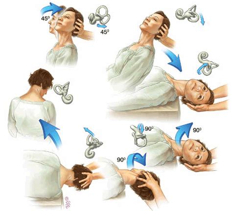 Vertigo Exercises Treatment Epley Maneuver - Image to u