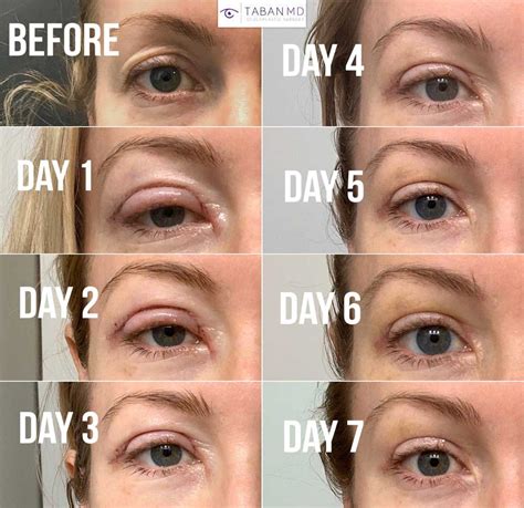 Upper Blepharoplasty Before and After Gallery | Taban MD