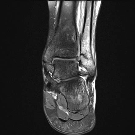 Fibula Stress Fracture Mri