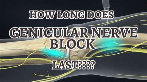 How Long Does Genicular Nerve Block Last? TIPSS