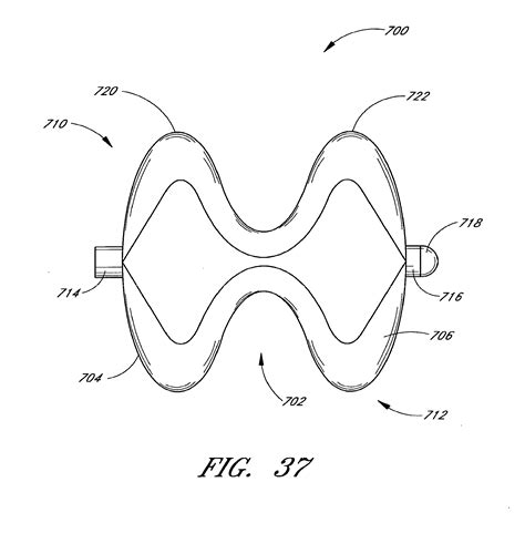 Patent Foramen Ovale Connecting Dots From Massive Pul - vrogue.co