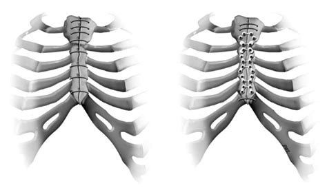 Rigid Sternal Fixation Improves Postoperative Recovery ~ Fulltext