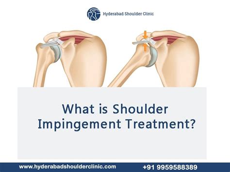 What is Shoulder Impingement Treatment? - shoulder clinic Hyderabad