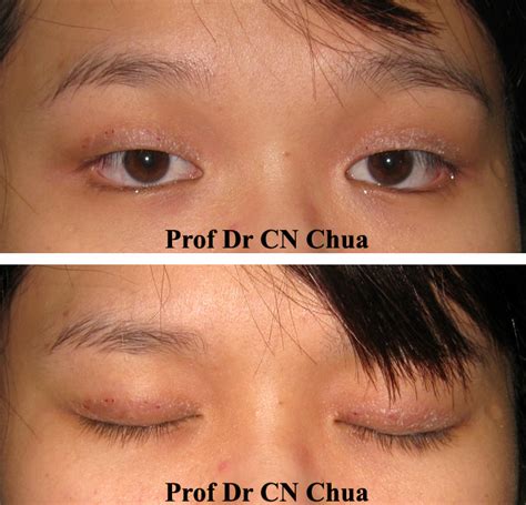 Eyelid Surgery by Prof Dr CN CHUA 蔡鐘能: Allergy to Tapes for Double Eyelids