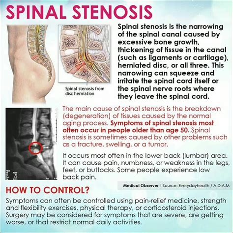 Health | Spinal stenosis, Stenosis, Lumbar spinal stenosis