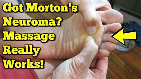 Morton's Neuroma Massage - Exercises to AVOID Surgery! | Morton's neuroma, Neuroma, Mortons ...