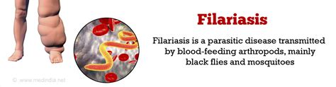 Filariasis - Causes, Symptoms, Diagnosis and Treatment , FAQs